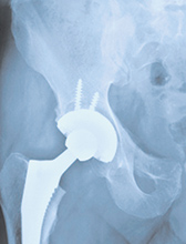 biomet-hip-replacement-1col.jpg